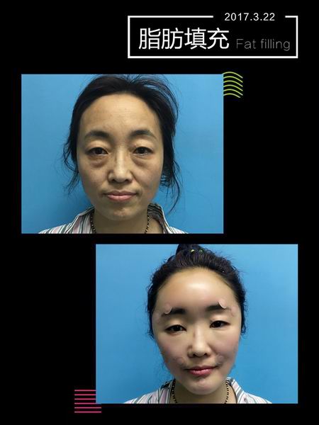 沈阳眼综合整形｜沈阳网红整形医院