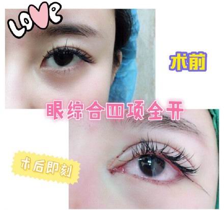 沈阳鼻综合整形｜沈阳做双眼皮哪家好