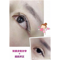 沈阳鼻综合整形｜沈阳做双眼皮哪家好