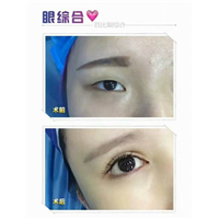 沈阳做双眼皮哪家好｜沈阳鼻部整形哪家好
