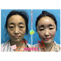 沈阳眼综合整形｜沈阳网红整形医院