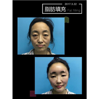沈阳眼综合整形｜沈阳网红整形医院