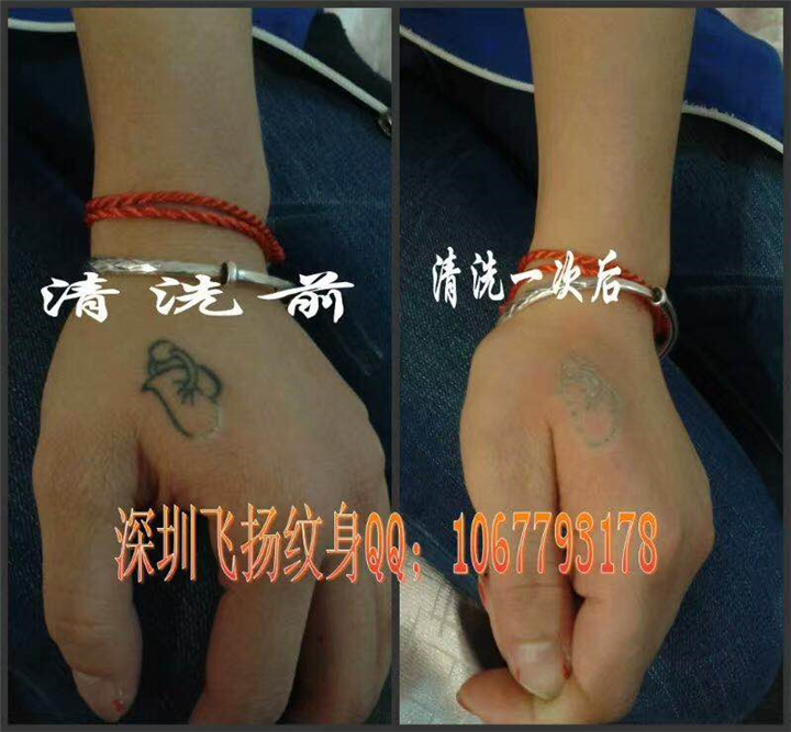深圳清洗纹身案例 4 