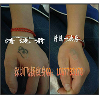 深圳清洗纹身案例 4 