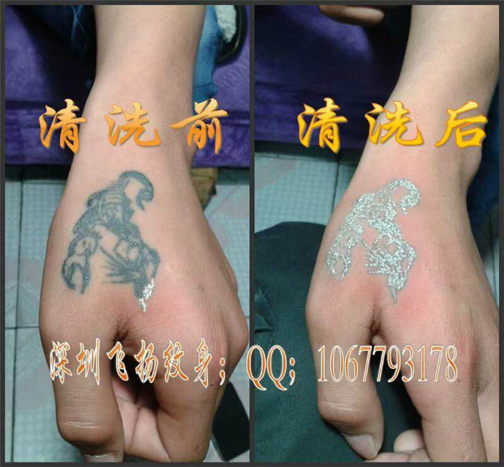 深圳清洗纹身案例 3 