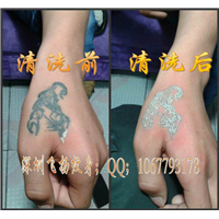 深圳清洗纹身案例 3 