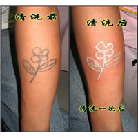深圳清洗纹身案例 5 
