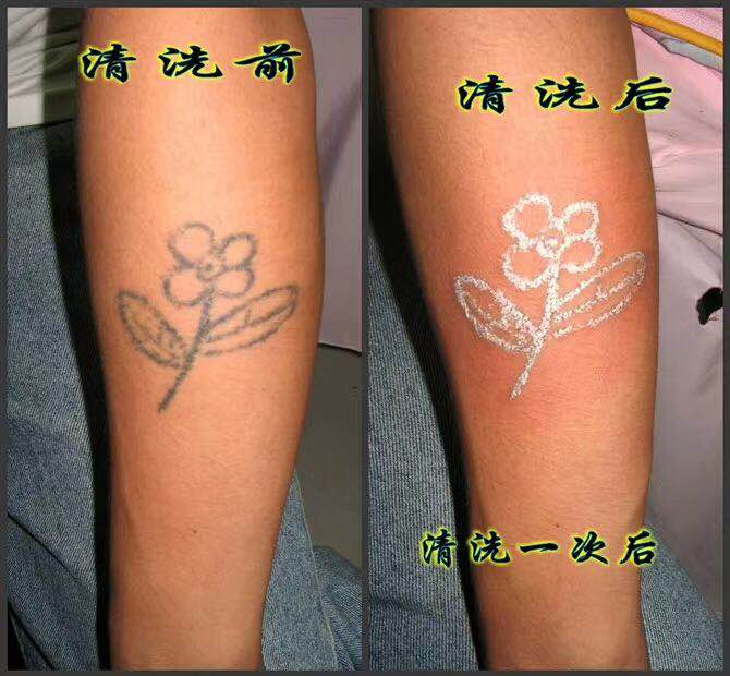 深圳清洗纹身案例 5 