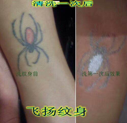 深圳清洗纹身案例 8 