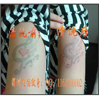 深圳清洗纹身案例 1 