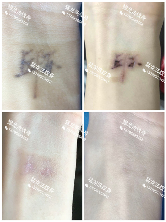深圳洗纹身