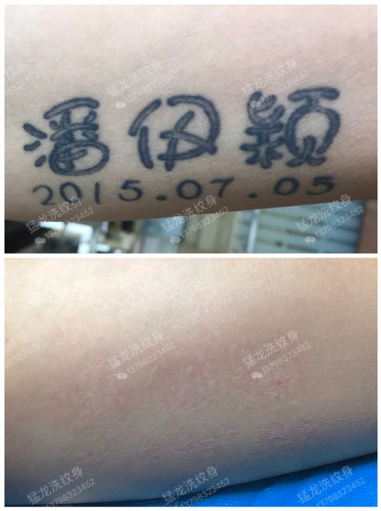 深圳洗纹身