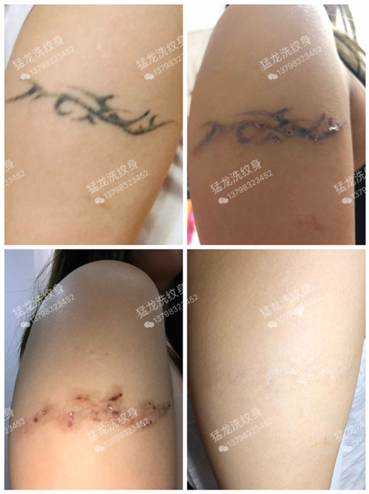 深圳洗纹身