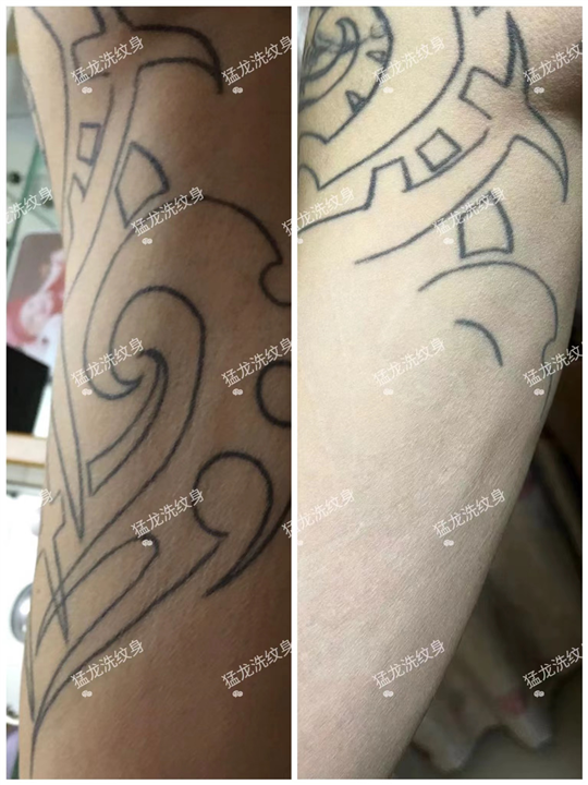 深圳宝安洗纹身找哪家