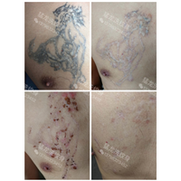 深圳洗纹身