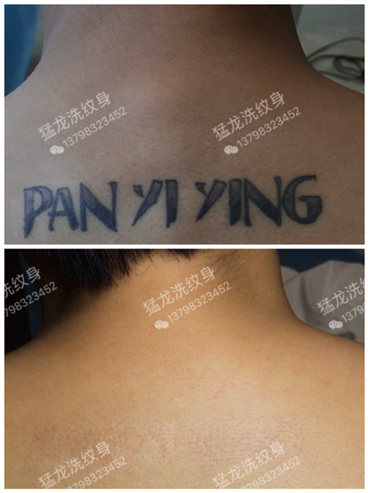 深圳洗纹身