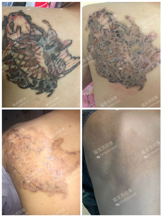 深圳洗纹身