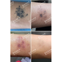 深圳猛龙洗彩色纹身