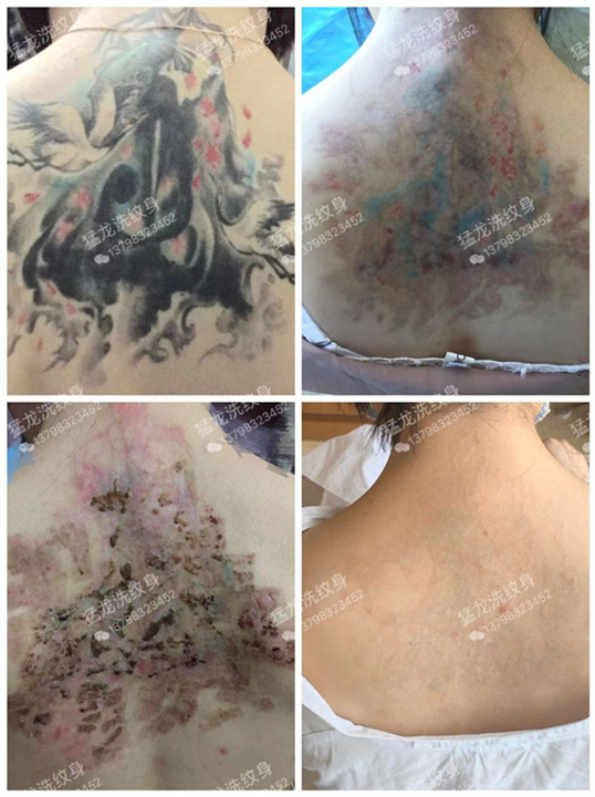 深圳洗纹身
