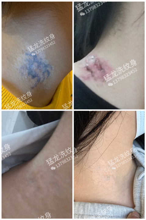 洗彩色纹身龙岗洗纹身