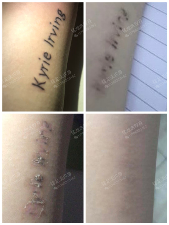 深圳洗纹身