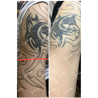 深圳罗湖洗纹身找谁