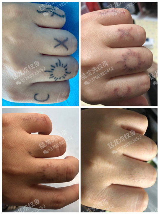 深圳洗纹身