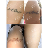 深圳洗纹身