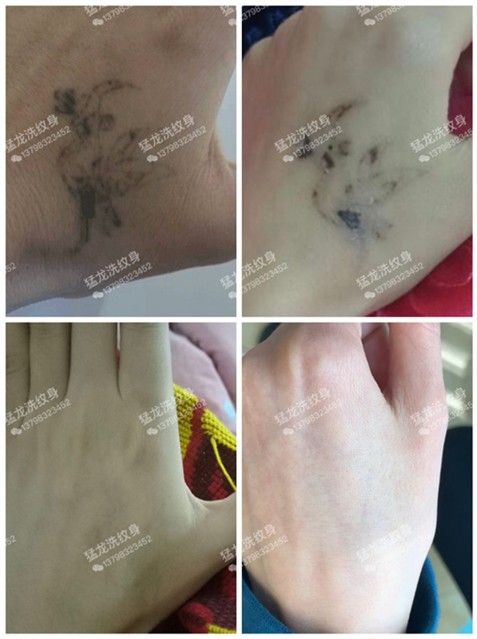 深圳洗纹身