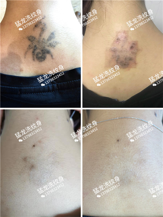 深圳洗纹身