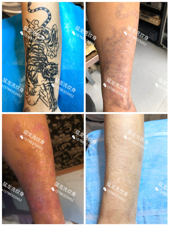 深圳洗纹身