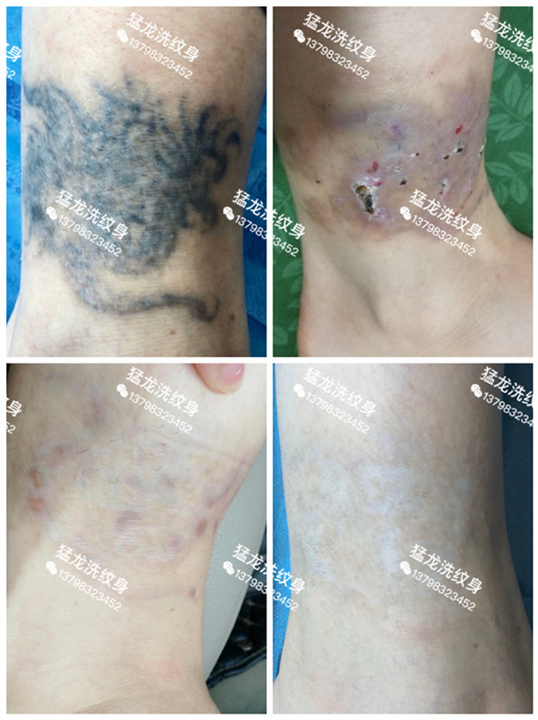 深圳洗纹身