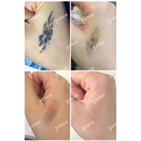 洗眉洗眼线深圳洗纹身