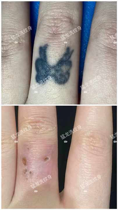 深圳去除纹身皮秒洗纹身