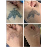 深圳洗纹身
