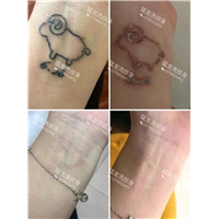 深圳洗纹身机构