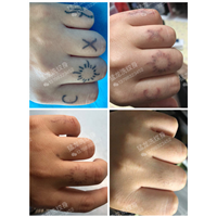 深圳洗纹身