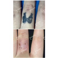 深圳去除纹身皮秒洗纹身