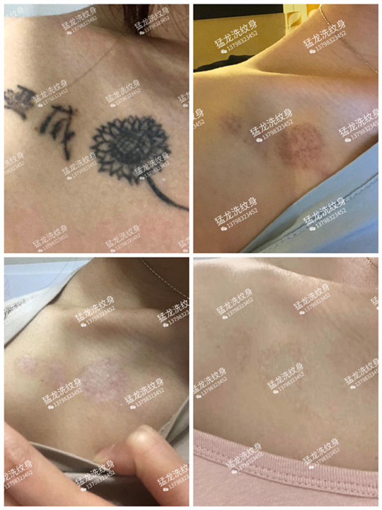 深圳洗纹身