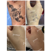 深圳洗纹身技术哪家好