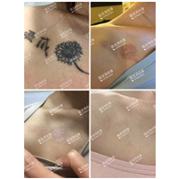 深圳洗纹身