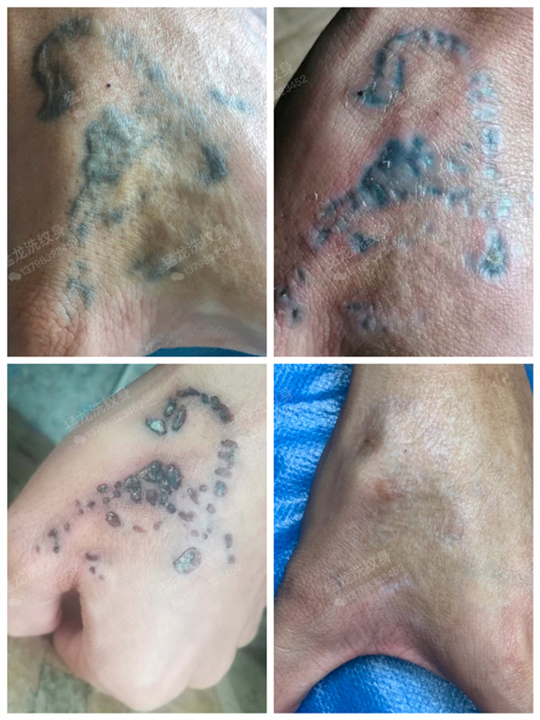 深圳洗纹身