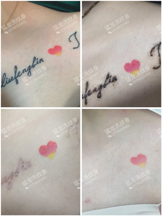 深圳洗纹身