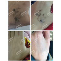 深圳洗纹身