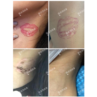 深圳洗彩色纹身找哪家
