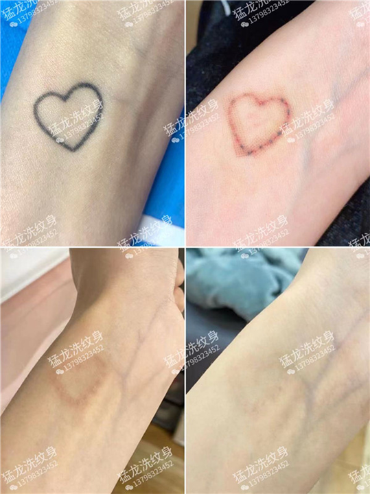 洗彩色纹身宝安洗纹身