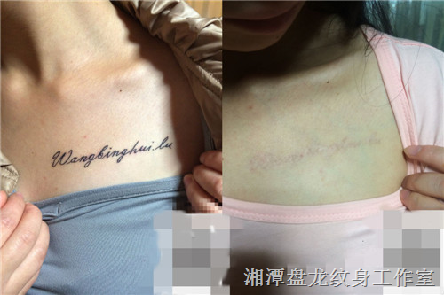 湘潭激光洗纹身|湘潭洗纹身 