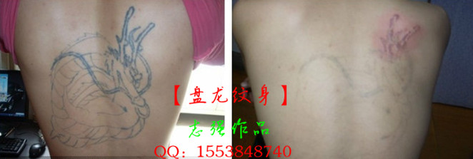湘潭哪里有洗纹身 
