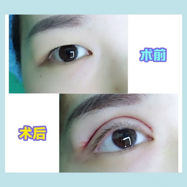 上海网红常去的整形|上海眼综合整形