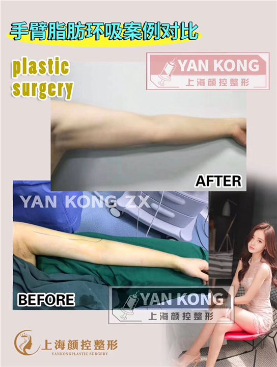 上海专业抽脂整形